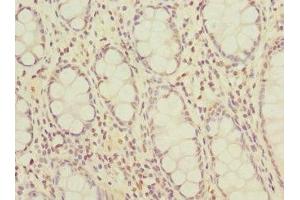 Immunohistochemistry of paraffin-embedded human colon cancer using ABIN7162234 at dilution of 1:100 (OGFR anticorps  (AA 1-280))