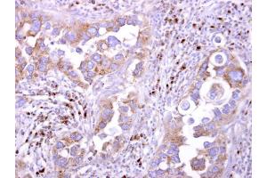 IHC-P Image LILRB5 antibody [N2C1], Internal detects LILRB5 protein at cytosol on human breast carcinoma by immunohistochemical analysis. (LILRB5 anticorps  (Internal Region))
