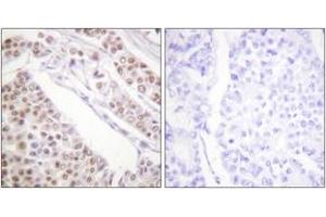 Immunohistochemistry analysis of paraffin-embedded human lung carcinoma tissue, using Histone H2B (Acetyl-Lys12) Antibody.