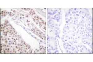 Immunohistochemistry analysis of paraffin-embedded human lung carcinoma tissue, using Histone H2B (Acetyl-Lys12) Antibody. (Histone H2B anticorps  (acLys12))