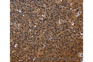 Immunohistochemistry of Human colon cancer using EXTL3 Polyclonal Antibody at dilution of 1:50 (EXTL3 anticorps)