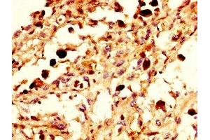 IHC image of ABIN7161390 diluted at 1:300 and staining in paraffin-embedded human melanoma performed on a Leica BondTM system.