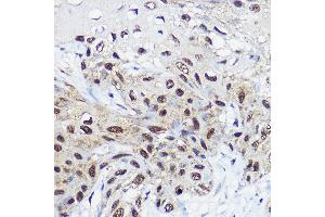 Immunohistochemistry of paraffin-embedded human esophageal cancer using SM Rabbit pAb (ABIN6132562, ABIN6148098, ABIN6148099 and ABIN6214424) at dilution of 1:100 (40x lens). (SMARCA1 anticorps  (AA 1-200))