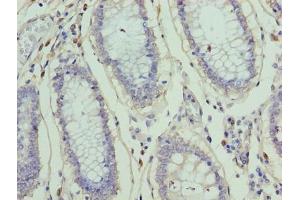 Immunohistochemistry of paraffin-embedded human colon cancer using ABIN7176373 at dilution of 1:100 (ZNF555 anticorps  (AA 1-200))