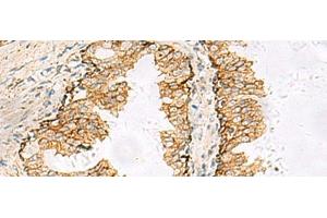Immunohistochemistry of paraffin-embedded Human prost at e cancer tissue using SH3YL1 Polyclonal Antibody at dilution of 1:55(x200) (SH3YL1 anticorps)