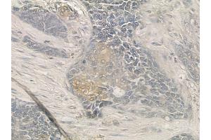ABIN6257231 and ABIN6273685 at 1/100 staining human breast carcinoma by IHC-P. (Keratin 77 anticorps  (Internal Region))