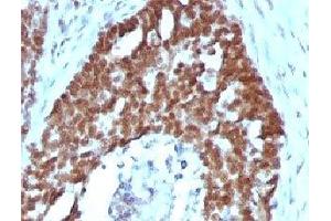 IHC testing of FFPE human ovarian carcinoma with Nucleolin antibody (clone NPC23-2). (Nucleolin anticorps)