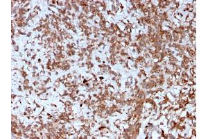Formalin-fixed, paraffin-embedded human Liver stained with Cathepsin K Mouse Monoclonal Antibody (CTSK/2792). (Cathepsin K anticorps  (AA 163-274))