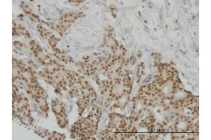 Immunoperoxidase of monoclonal antibody to PGR on formalin-fixed paraffin-embedded human breast cancer. (Progesterone Receptor anticorps  (AA 1-110))