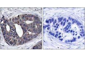 Immunohistochemistry analysis of paraffin-embedded human breast carcinoma tissue, using p62 Dok (Ab-362) Antibody. (DOK1 anticorps  (AA 329-378))