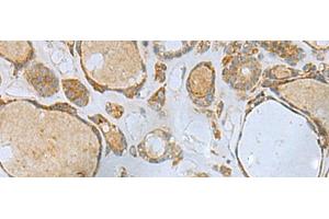 Immunohistochemistry of paraffin-embedded Human thyroid cancer tissue using ENKD1 Polyclonal Antibody at dilution of 1:80(x200) (ENKD1 anticorps)
