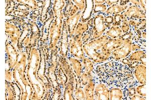 ABIN6260970 and ABIN6276865 at 1/100 staining Human kidney cancer and adjacent normal tissues by IHC-P. (COPS5 anticorps  (Internal Region))