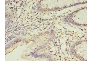 Immunohistochemistry of paraffin-embedded human colon cancer using ABIN7152867 at dilution of 1:100
