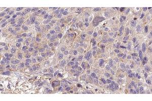 ABIN6273207 at 1/100 staining Human melanoma tissue by IHC-P. (CFHR3 anticorps)