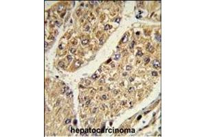 Formalin-fixed and paraffin-embedded human hepatocarcinoma reacted with CSGALNACT2 Antibody (Center), which was peroxidase-conjugated to the secondary antibody, followed by DAB staining.
