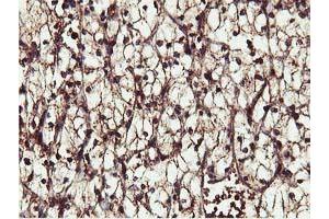 Immunohistochemical staining of paraffin-embedded Carcinoma of Human kidney tissue using anti-IDS mouse monoclonal antibody. (IDS anticorps)