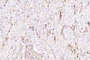 Immunohistochemistry analysis of paraffin-embedded human cervical cancer using NXF2 (ABIN7074901) at dilution of 1: 3000 (NXF2 anticorps)
