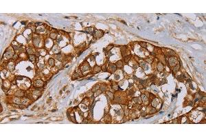 Immunohistochemistry of paraffin-embedded Human breast cancer tissue using MTUS1 Polyclonal Antibody at dilution 1:40 (MTUS1 anticorps)