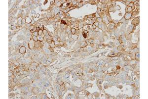 IHC-P Image Immunohistochemical analysis of paraffin-embedded OVCAR3 xenograft, using GRK2, antibody at 1:500 dilution.