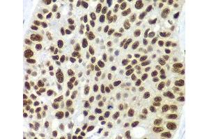 Immunohistochemistry of paraffin-embedded Human lung cancer using SF3B2 Polyclonal Antibody at dilution of 1:100 (40x lens). (SF3B2 anticorps)