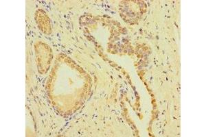 Immunohistochemistry of paraffin-embedded human prostate cancer using ABIN7148722 at dilution of 1:100 (CSMD2 anticorps  (AA 1-225))