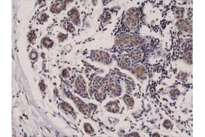 Immunohistochemical staining (Formalin-fixed paraffin-embedded sections) of human breast cancer with DIABLO monoclonal antibody, clone RM271 . (DIABLO anticorps  (C-Term))