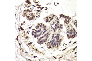 Immunohistochemistry of paraffin-embedded Human mammary cancer using INTS6 antibody at dilution of 1:100 (x400 lens). (INTS6 anticorps)
