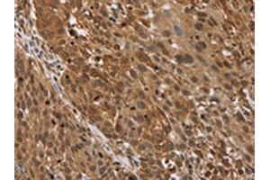 The image on the left is immunohistochemistry of paraffin-embedded Human lung cancer tissue using ABIN7192693(STMN2/STMN3/STMN4 Antibody) at dilution 1/45, on the right is treated with synthetic peptide. (STMN2/STMN3/STMN4 anticorps)