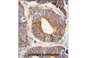 DNAJA1 Antibody (Center) (ABIN652030 and ABIN2840506) immunohistochemistry analysis in formalin fixed and paraffin embedded human prostate carcinoma followed by peroxidase conjugation of the secondary antibody and DAB staining.