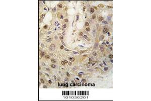 Formalin-fixed and paraffin-embedded human lung carcinoma tissue reacted with cGKII antibody , which was peroxidase-conjugated to the secondary antibody, followed by DAB staining. (PRKG2 anticorps  (C-Term))