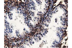 Immunohistochemical staining of paraffin-embedded Carcinoma of Human kidney tissue using anti-MICAL1 mouse monoclonal antibody. (MICAL1 anticorps)