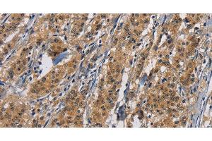 Immunohistochemistry of paraffin-embedded Human gastric cancer tissue using PIKFYVE Polyclonal Antibody at dilution 1:50 (PIKFYVE anticorps)