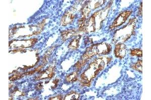IHC testing of FFPE human renal cell carcinoma with IFN gamma antibody (clone IFNG/466). (Interferon gamma anticorps)
