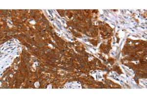 Immunohistochemistry of paraffin-embedded Human cervical cancer tissue using HOXB1 Polyclonal Antibody at dilution 1:40 (HOXB1 anticorps)