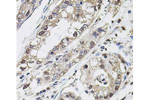 Immunohistochemistry of paraffin-embedded Human gastric cancer using CA9 Polyclonal Antibody at dilution of 1:100 (40x lens). (CA9 anticorps)