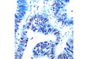 Immunohistochemistry of paraffin-embedded human colon carcinoma using USP7/HAUSP Rabbit mAb (ABIN7271168) at dilution of 1:100 (40x lens). (USP7 anticorps)
