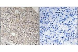 Immunohistochemistry analysis of paraffin-embedded human prostate carcinoma tissue, using AMOTL1 Antibody. (AMOTL1 anticorps  (AA 441-490))