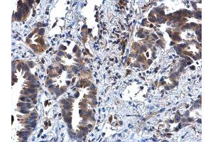 IHC-P Image IL1 Receptor 2 antibody [N3C3] detects IL1 Receptor 2 protein at cytoplasm in human lung cancer by immunohistochemical analysis.