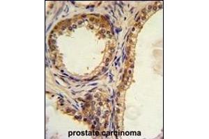 Formalin-fixed and paraffin-embedded human prostate carcinoma with CREB3L1 Antibody (C-term), which was peroxidase-conjugated to the secondary antibody, followed by DAB staining.