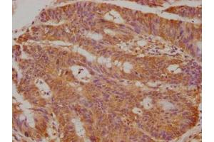 Immunohistochemical of paraffin-embedded human colon cancer using ABIN7173328 at dilution of 1:50 (TFF3 anticorps)