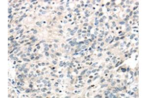 The image on the left is immunohistochemistry of paraffin-embedded Human ovarian cancer tissue using ABIN7191116(IQGAP2 Antibody) at dilution 1/40, on the right is treated with synthetic peptide.