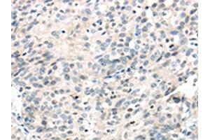 The image on the left is immunohistochemistry of paraffin-embedded Human ovarian cancer tissue using ABIN7191116(IQGAP2 Antibody) at dilution 1/40, on the right is treated with synthetic peptide. (IQGAP2 anticorps)