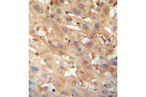 Immunohistochemistry analysis in formalin fixed and paraffin embedded human hepatocarcinoma reacted with NEU4 Antibody (C-term) followed which was peroxidase conjugated to the secondary antibody and followed by DAB staining. (Sialidase 4 anticorps  (C-Term))