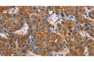 Immunohistochemistry of paraffin-embedded Human liver cancer tissue using APLNR Polyclonal Antibody at dilution 1:50 (Apelin Receptor anticorps)