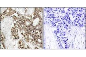 Immunohistochemistry analysis of paraffin-embedded human breast carcinoma, using p44/42 MAP Kinase (Phospho-Tyr204) Antibody.