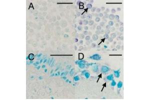 IHC staining for viral capsid protein with ABIN1000236: (A) Uninfected HeLa cells, (B) HRV16-infected HeLa cells, (C) Negative bronchial biopsy section, (D) Positive bronchial biopsy section. (Rhinovirus 16 anticorps)