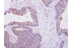 IHC-P Image H6PD antibody [N2N3] detects H6PD protein at cytoplasm on human colon carcinoma by immunohistochemical analysis. (Glucose-6-Phosphate Dehydrogenase anticorps)