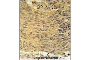 LCLT1 Antibody (C-term) (ABIN651910 and ABIN2840449) immunohistochemistry analysis in formalin fixed and paraffin embedded human lung carcinoma followed by peroxidase conjugation of the secondary antibody and DAB staining. (LCLAT1 anticorps  (AA 296-324))