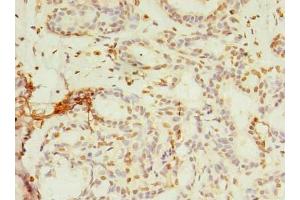 Immunohistochemistry of paraffin-embedded human breast cancer using ABIN7142992 at dilution of 1:100 (SMPDL3A anticorps  (AA 51-350))