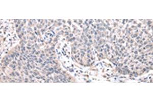 Immunohistochemistry of paraffin-embedded Human lung cancer tissue using ZNF239 Polyclonal Antibody at dilution of 1:25(x200) (ZNF239 anticorps)
